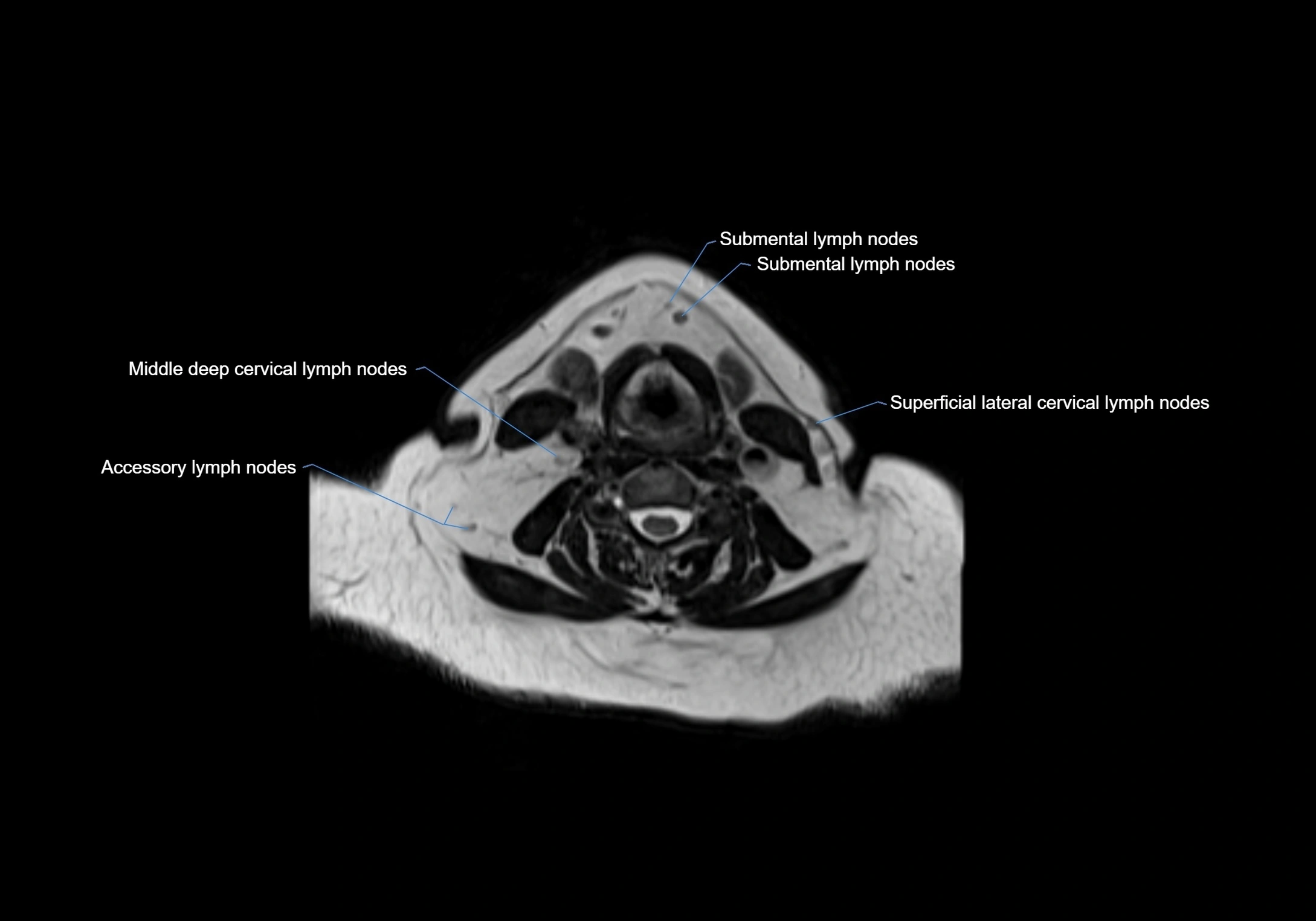 Neck axial  lymph node cross sectional MRI anatomy 3T MRI  image-img-00001-00061.webp